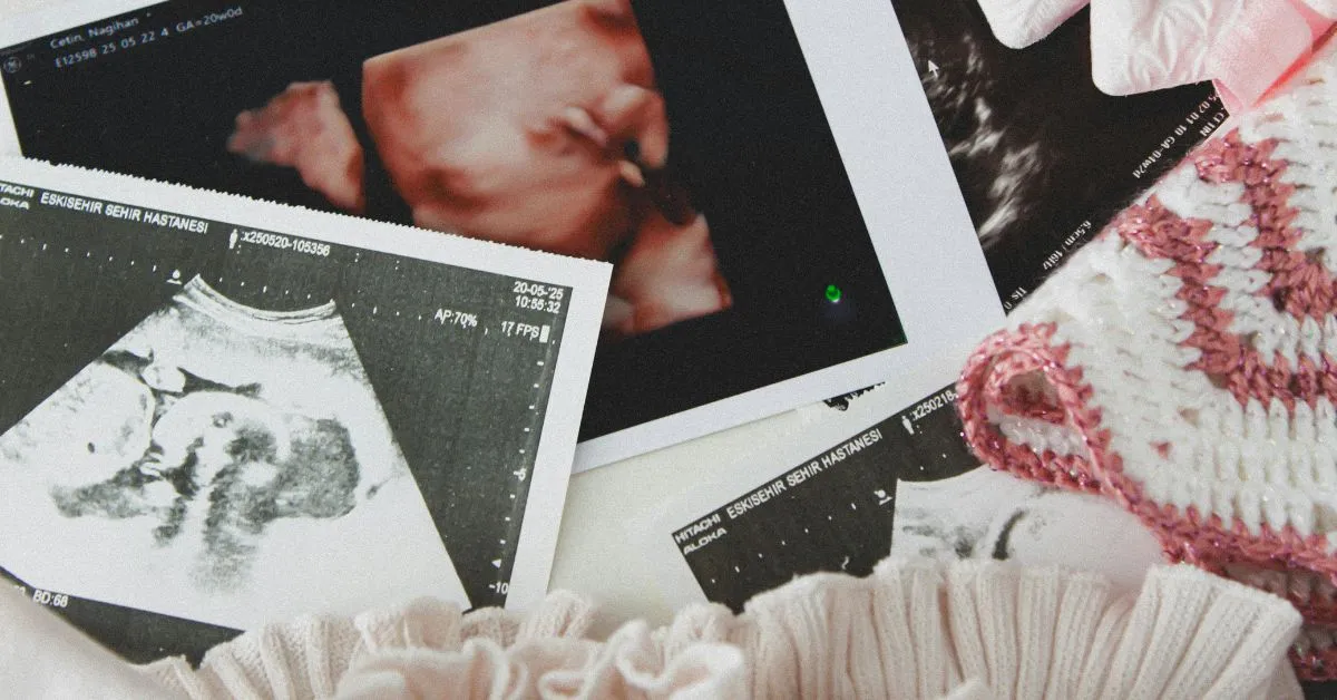 # FAQs – Alimentos Gravídicos: Quem Pode Pedir e Como a Justiça Define o Valor ## 1. Quem pode pedir alimentos gravídicos? A **gestante** pode pedir alimentos gravídicos durante a gravidez, em nome próprio, contra o suposto pai. O objetivo é ajudar a custear despesas da gestação. A análise depende do caso e da prova apresentada. --- ## 2. Precisa de exame de DNA para pedir alimentos gravídicos? Não necessariamente. Em regra, a Justiça analisa **indícios de paternidade**, como mensagens, fotos, testemunhas e contexto da relação. O exame de DNA pode ser discutido depois, se necessário. --- ## 3. O que os alimentos gravídicos cobrem? Podem incluir despesas da gravidez, como: * consultas e exames * medicamentos * alimentação especial * transporte * parto e internação O valor varia conforme a necessidade da gestante e a possibilidade financeira do réu. --- ## 4. Como a Justiça define o valor dos alimentos gravídicos? O juiz costuma avaliar dois pontos: * **necessidade da gestação** * **capacidade financeira do suposto pai** Não há valor fixo. Cada caso exige análise individual. --- ## 5. O pai precisa pagar metade de todas as despesas da gravidez? Não existe regra automática de 50%. A contribuição pode ser maior, menor ou proporcional, conforme as provas do processo, a renda das partes e os custos reais da gestação. --- ## 6. Alimentos gravídicos viram pensão alimentícia depois que o bebê nasce? Sim, em muitos casos. Após o nascimento, os alimentos gravídicos podem ser convertidos em **pensão alimentícia para a criança**, conforme prevê a legislação. --- ## 7. É possível pedir alimentos gravídicos mesmo sem casamento ou união estável? Sim. O pedido não depende de casamento ou união estável formal. O que importa é a existência de **indícios de paternidade** e a demonstração das despesas relacionadas à gravidez. --- ## 8. O suposto pai pode contestar os alimentos gravídicos? Sim. Ele pode apresentar defesa, contestar os indícios de paternidade, questionar o valor pedido e demonstrar sua realidade financeira. A decisão dependerá das provas do processo. --- ## 9. O pedido de alimentos gravídicos pode ser feito a qualquer momento da gravidez? Em regra, sim, desde que a gestação ainda esteja em curso. Quanto antes houver orientação jurídica e organização dos documentos, maior a chance de o pedido ser analisado em tempo útil. --- ## 10. O que fazer se a gestante não recebe ajuda financeira durante a gravidez? É importante reunir exames, comprovantes de despesas e indícios de paternidade. Com esses documentos, a situação pode ser avaliada juridicamente. Cada caso deve ser analisado com cuidado, especialmente por envolver direitos sensíveis.